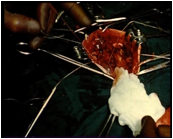 ::SURGERY FISSURE.jpg