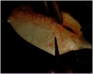 ::SURGERY FISSURE2.jpg
